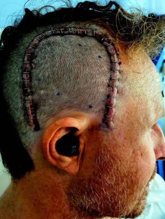 Kelly Smith after brain surgery. Picture – contributed.