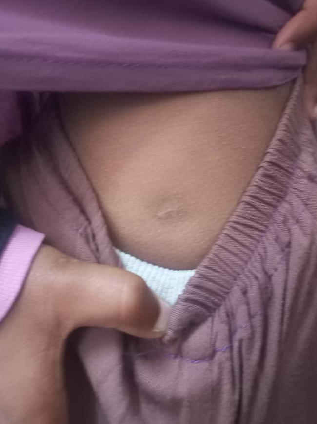 A shrapnel scar on the hip of the mother’s eight-year-old daughter.