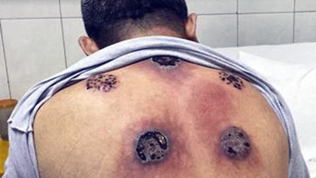 Giant burns cover a 63-year-olds back after ‘cupping’. Picture: CEN/Australscope