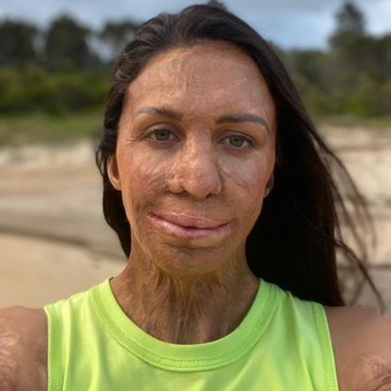 Turia Pitt’s life changed forever when she was caught in a bushfire in 2011. Picture: Instagram.