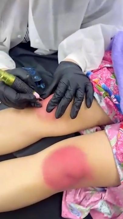 Beauty clinic gives bizarre pink kneecap tattoo treatment