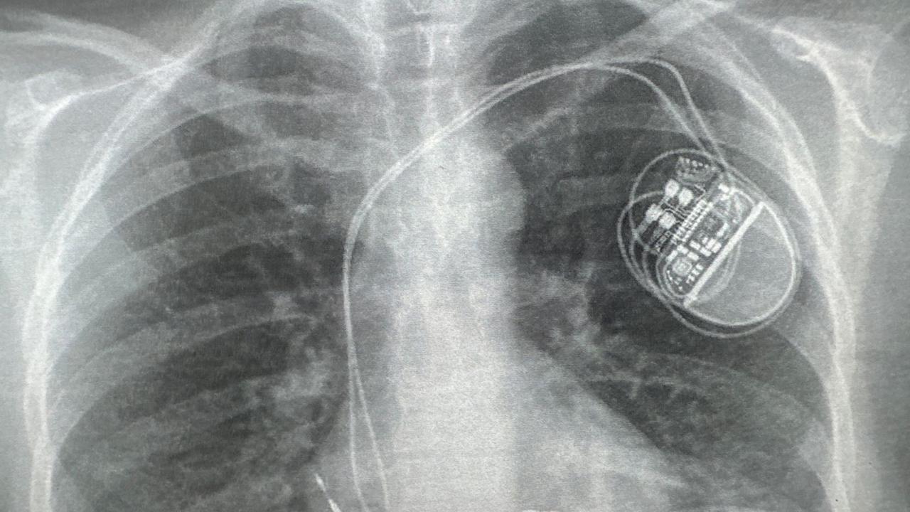 Lauren Pfeiffer was only 37 years old when she was fitted with a pacemaker. Picture: Supplied