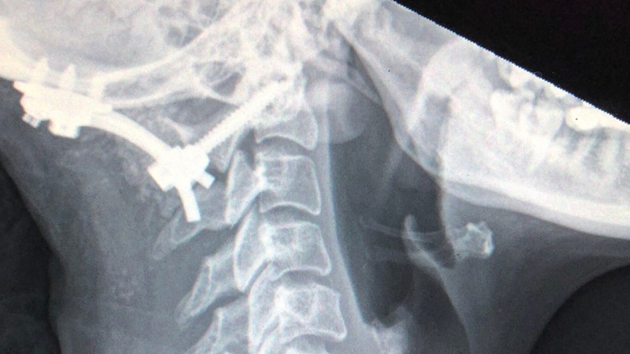 A surgeon used rods and screws to fix her skull to her spine and then removed a piece of bone from her skull and spine to create more room for her brain, but the surgery failed. Source: GoFundMe