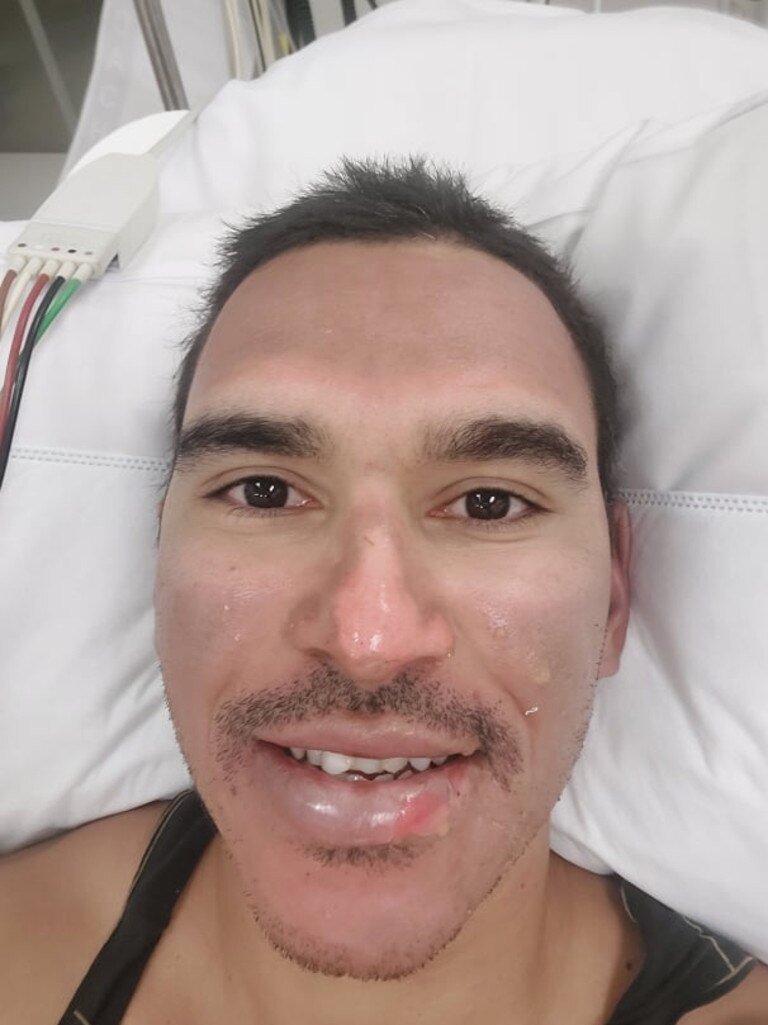 Central Queensland miner Nigel Purcell burnt several nerve endings on his face after a fuel explosion in Sarina. This photo was taken just hours after the accident on Thursday, January 6 2022. Picture: Nigel Purcell.