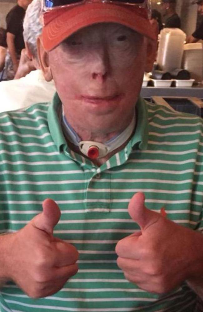 Patrick Hardison Face transplant for fireman revealed in amazing