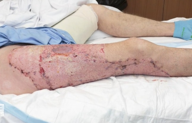 The 40-year-old man has a long road to recovery ahead. Picture: 9 News