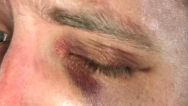 The officer suffered bruising around his eye but could have easily lost his vision. Picture: Supplied