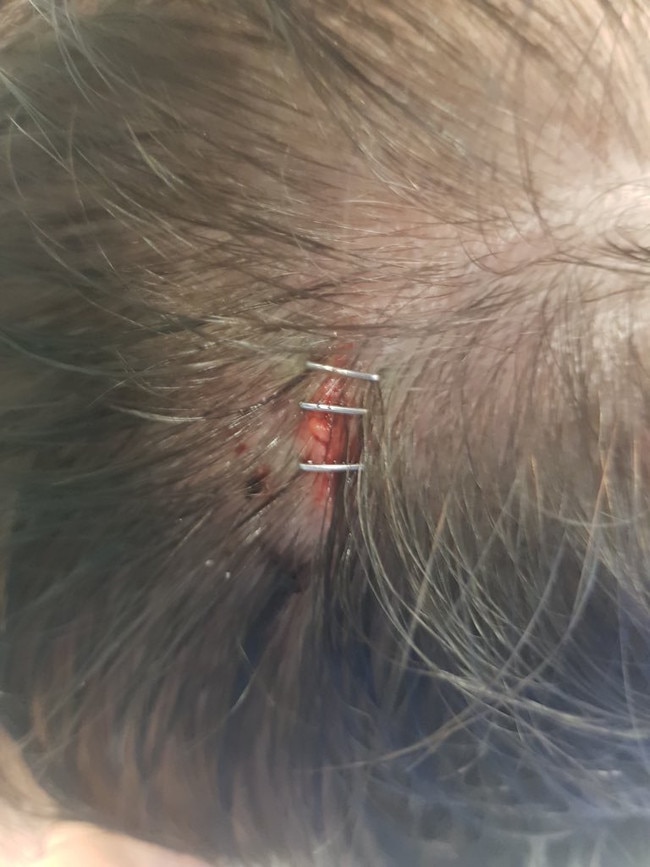 He is said to have needed three staples to his head. Picture: Supplied