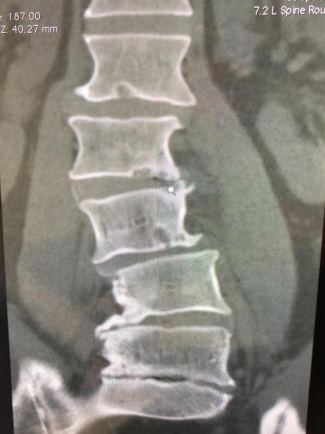 Dermott Brereton’s back x rays. Herald Sun.