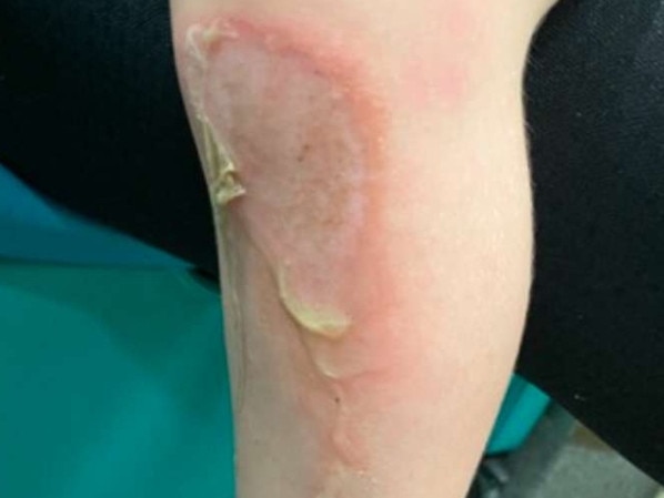 Oakleigh suffered burns on a metal slide in Grafton Jacaranda Park.