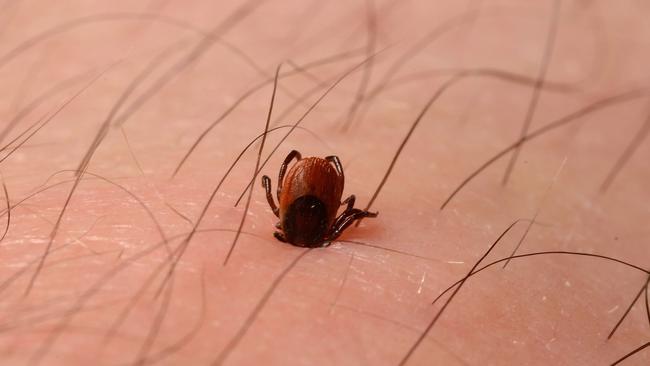 Deer tick embedded in skin of leg. These ticks are approximately 2.5mm long and can transmit Lyme disease to humans. Credit: Ashley Prytherch, Royal Surrey County Hospital NHS Foundation Trust/Wellcome Awards