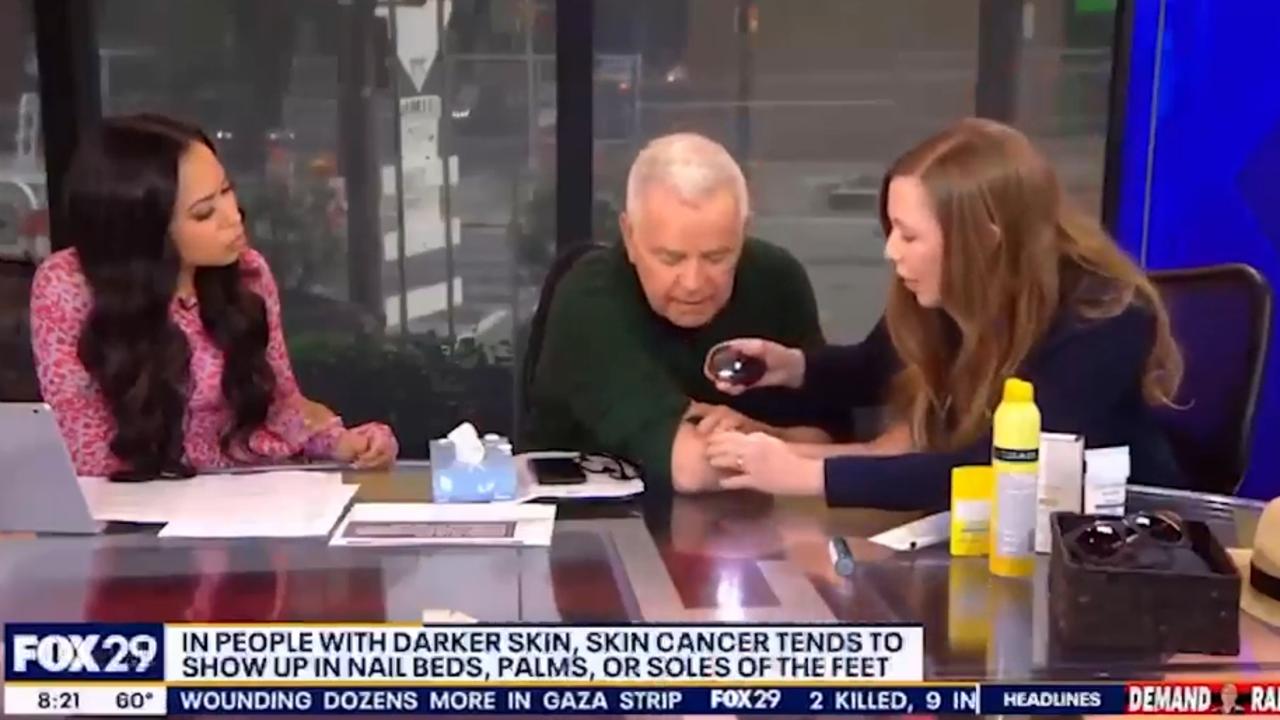 TV host Mike Jerrick is told he has skin cancer during a live TV segment with a dermatologist from the Tara Miller Melanoma Center.