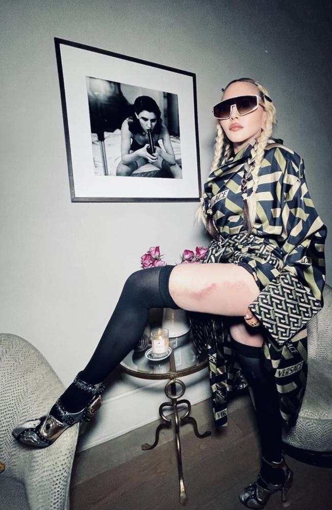 Madonna revealed a large bruise on her leg.