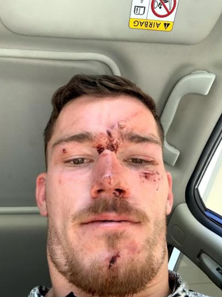 Tom Starling after an incident with police. Picture supplied