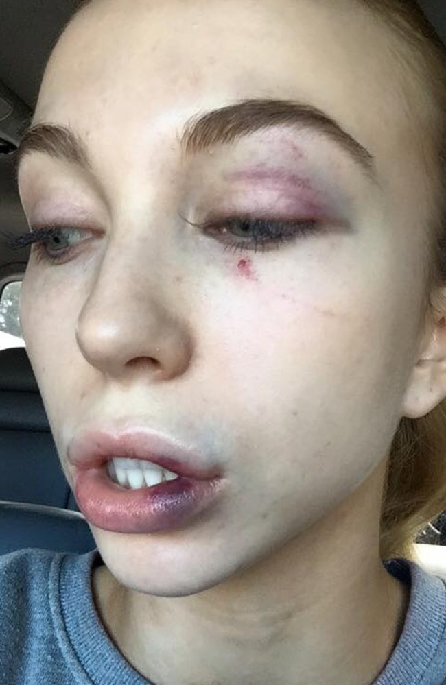 Elise Chambellant’s face following the attack.
