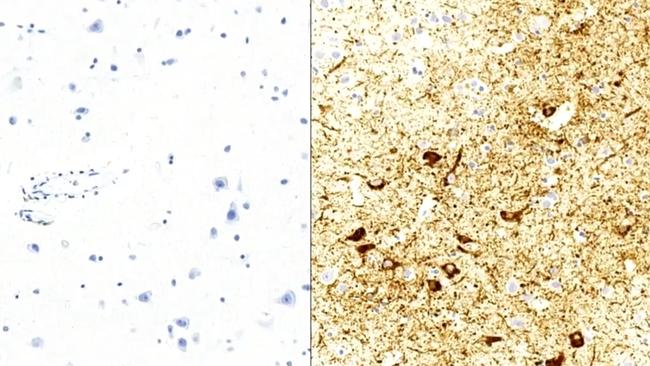 These are tissue samples – a healthy brain on the left, the right Keith's with brown CTE lesions. Photo: Channel 9