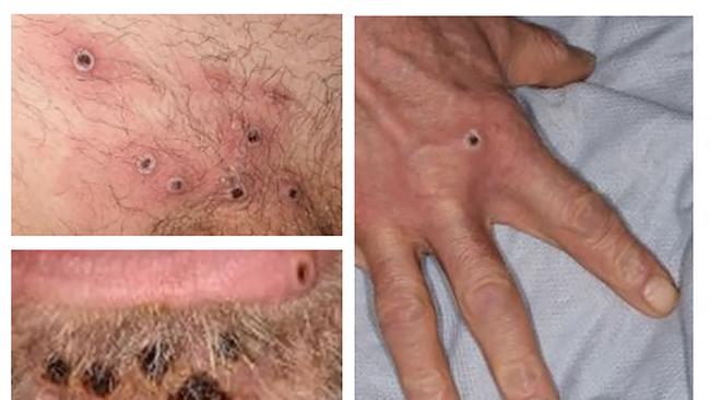 A collage of monkeypox lesions released by UK health authorities. Picture: AFP