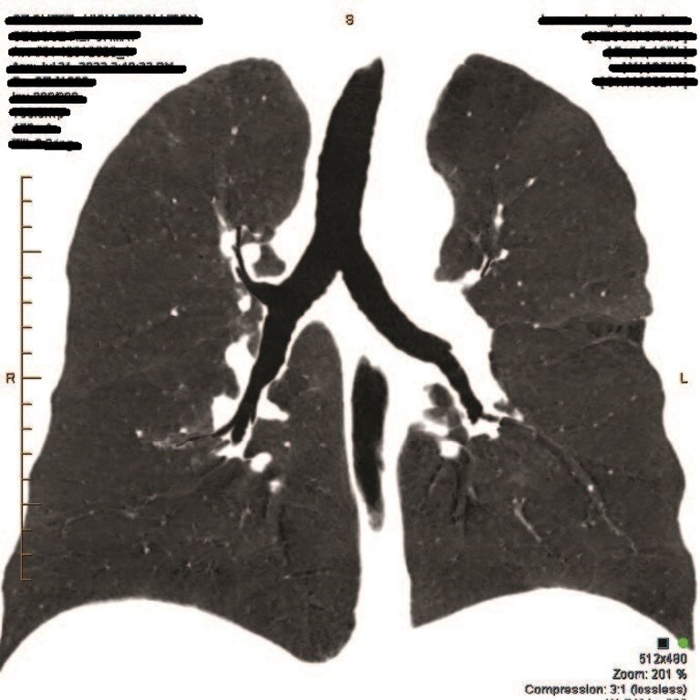 A scan of former Central Queensland miner Craig Keogh's lungs.