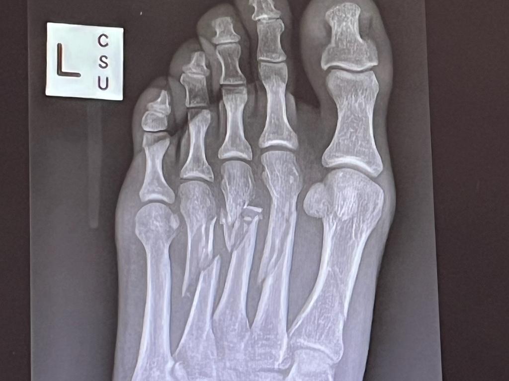 Jason Collett has broken his index, middle and fourth toes on his left foot. Photo: Jason Collett.