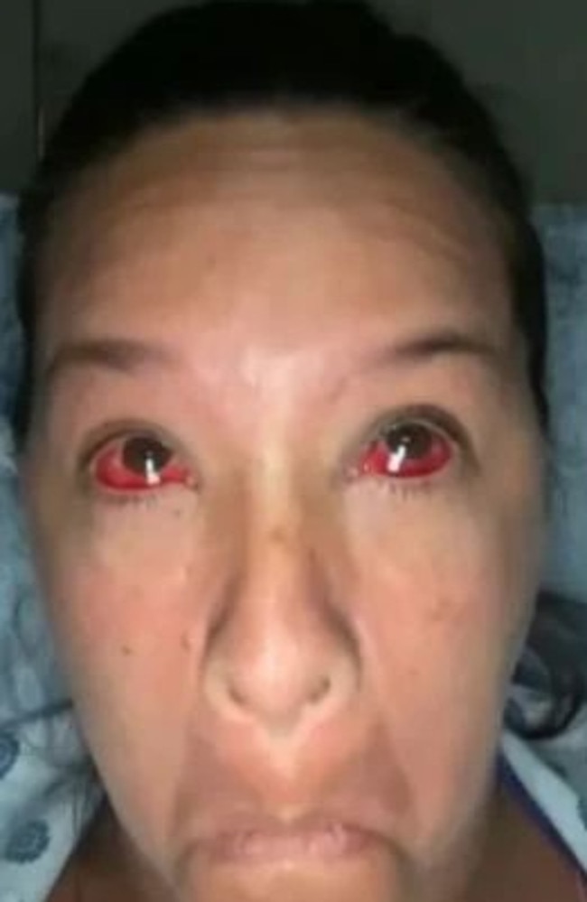 A woman has left people stunned after revealing she burst every blood vessel in her face when giving birth. Picture: TikTok