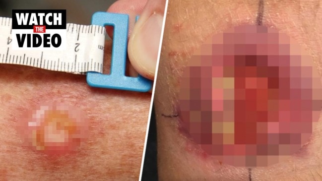 Flesh-eating skin infection found in inner Melbourne for the first time