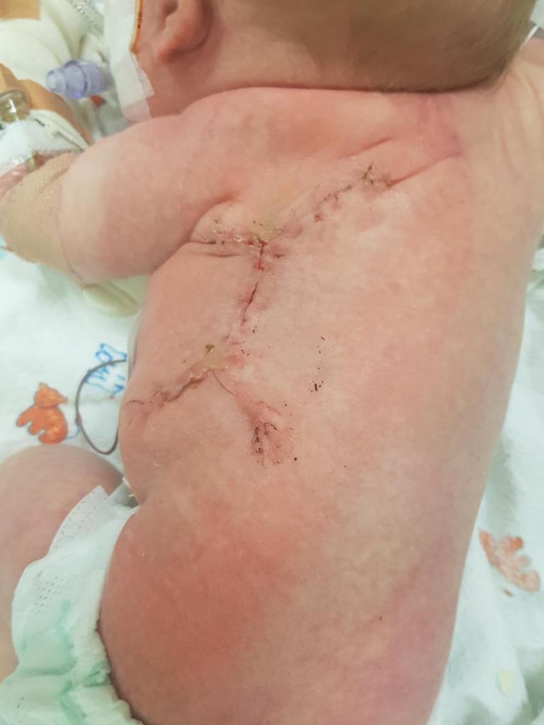 Johnny Farrant recovering from surgery after he was born with spina bifida. Photo: Supplied.