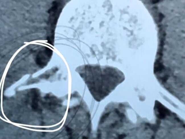 Scan image from Mike Baird's Facebook page showing a fractured vertebra