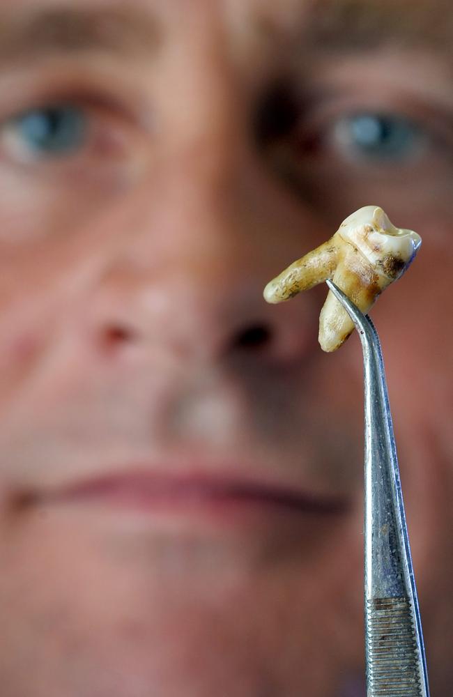 Forensic Odontologist Dr Richard Bassed with a tooth.