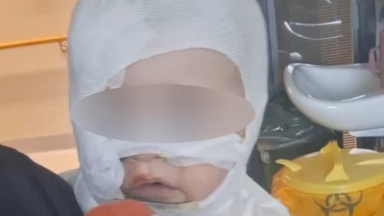 Heartwarming update on baby burned in park