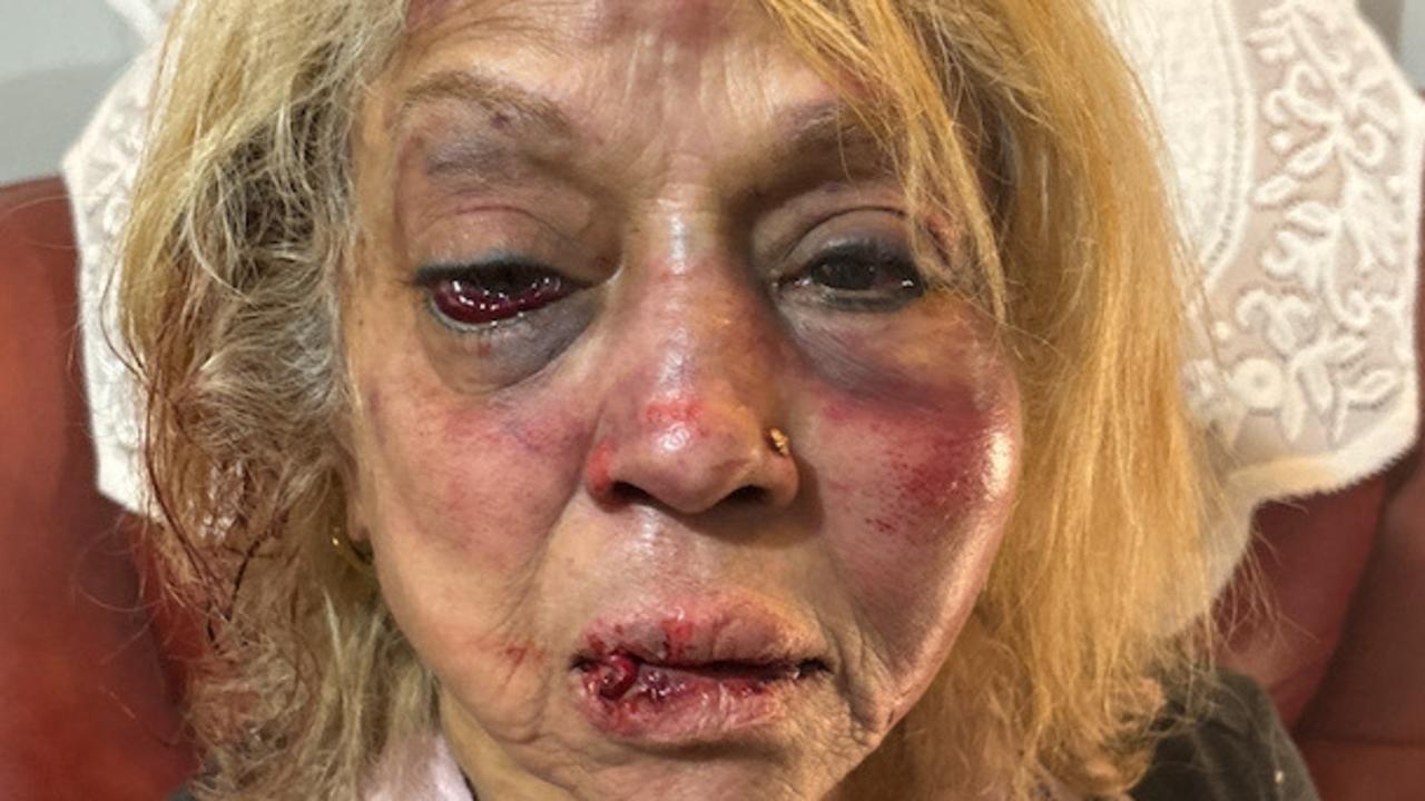 Ninette Simons received severe facial bruising and swelling after she was allegedly assaulted during a shocking home invasion. Picture: WA Police/Supplied