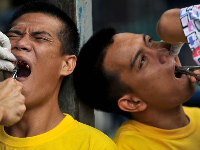 Inmates squirm as they receive dental treatment at the Quezon City jail. Picture: Noel Celis