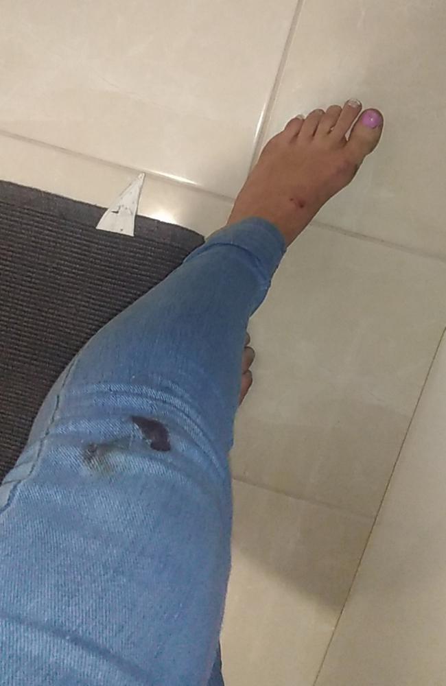 Injuries sustained by West Launceston woman Crystal Aldridge, 44, during an unlawful arrest by Tasmania Police officers at her unit on April 7, 2022. Picture: Supplied