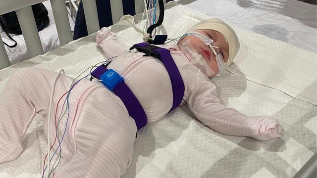 Laryngomalacia and Central Sleep Apnoea (CSA): Baby choked on breast milk