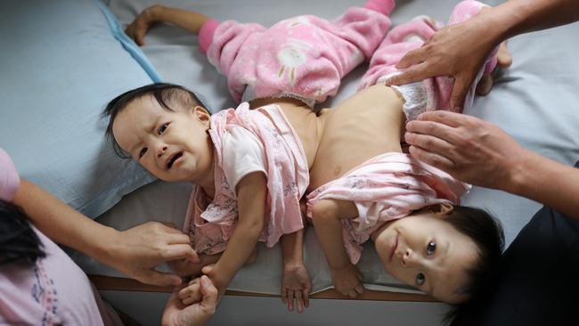 Paediatric surgeon Dr Karma Sherub examines the girls. it’s unclear how much of their bowels and liver they share. Picture: Alex Coppel