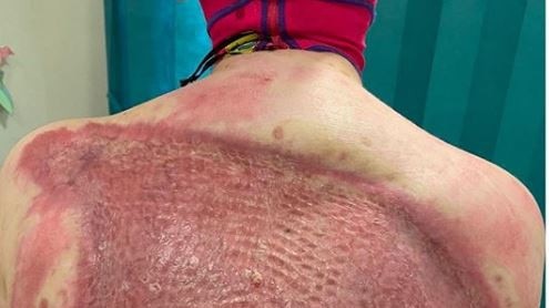 Stephanie Browitt suffered horrific burns. Picture: Instagram