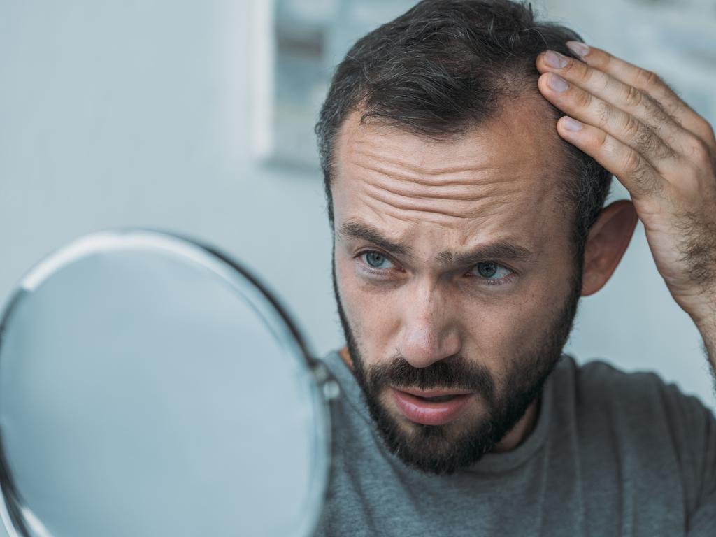 Significant balding affects about one in five men in their 20s. Picture: iStock.