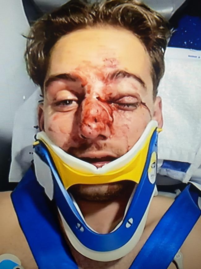 Andersen suffered serious injuries following the attack. Picture: Supplied