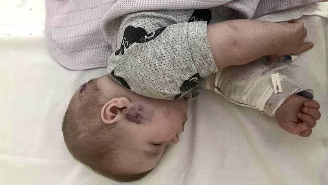 A six-month-old baby has had to have emergency surgery after being mauled by a dog on the Gold Coast. Picture: Facebook