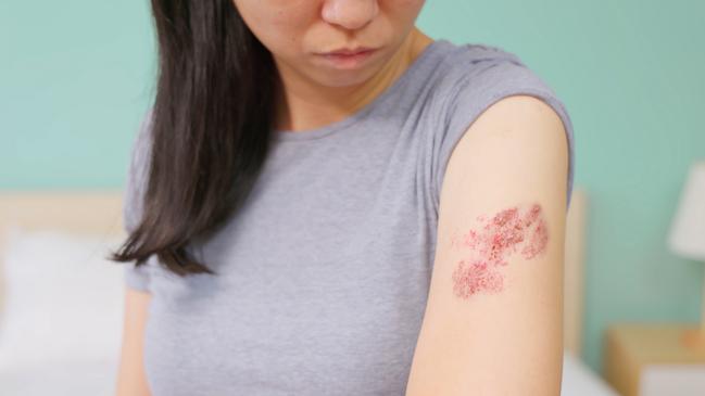 Woman with shingles on the skin she feels very painful   i stock image