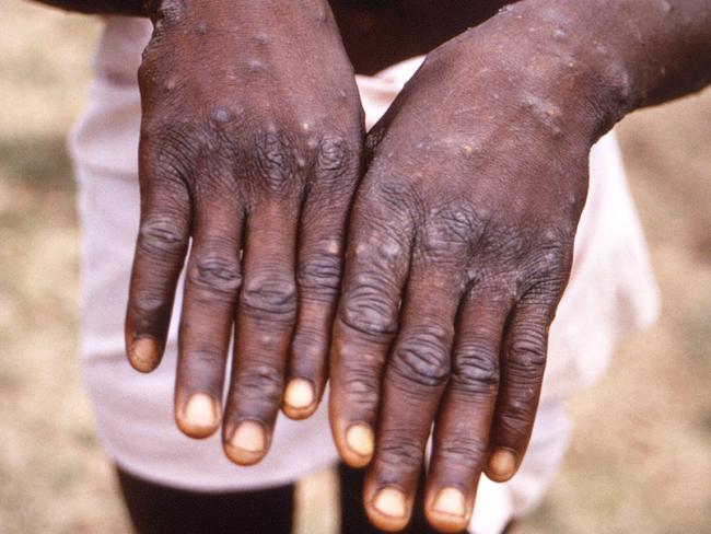 People in New South Wales have been warned to keep an eye out for symptoms of monkeypox after 11 cases of the virus were confirmed in the state.