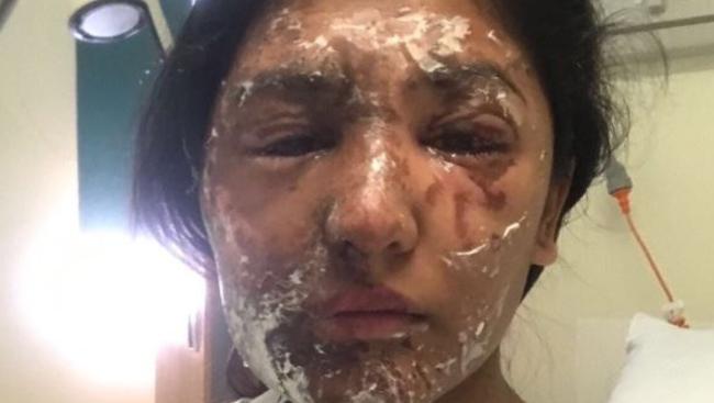 Resham Khan has told of a terrifying acid attack on her 21st birthday. Picture: GoFund Me