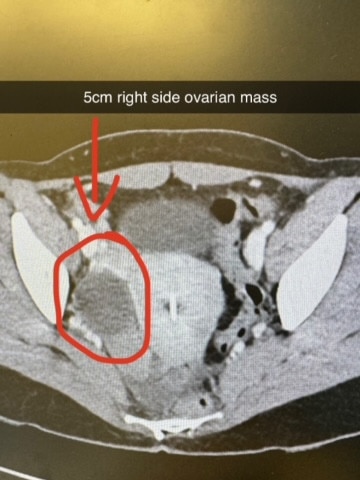 Scan showing the 5cm mass on Ashley Evans right ovary. Picture: Supplied