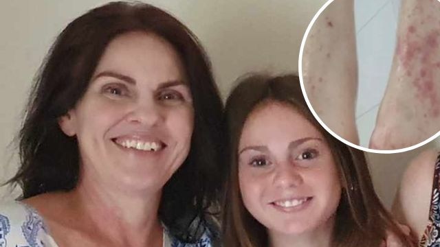 A Brisbane mum of three has revealed that she tried to take her own life due to her struggle living with a severe skin condition.