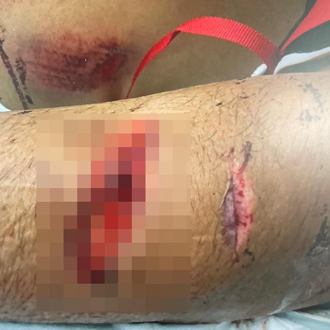 Picture of brawl victim's injuries tendered to court.