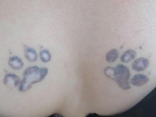 Tattoo removal: Laser machines causing horrific skin damage  —  Australia's leading news site