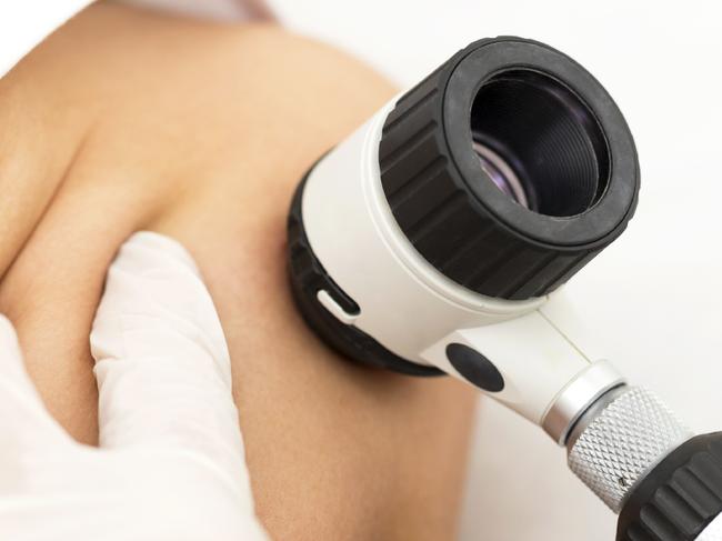 Doctor examining melanoma with dermascope