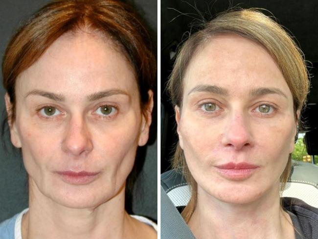 A woman who “always” had what’s been deemed “resting b*tch face” has revealed the drastic decision she made to cure it.