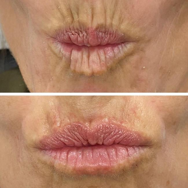 The ferning technique removes unwanted wrinkles. Perfectly Smooth