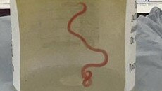 It's the world's first known case of a roundworm from a carpet python infecting a human. Picture: ANU