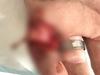 Miner’s finger partially amputated in shocking work injury